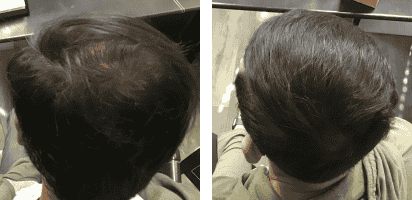 Hair Restoration Center in Palm Beach