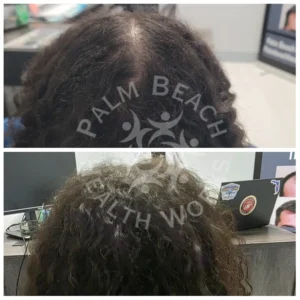 Before and After - Women